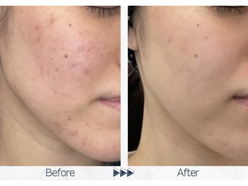 リレイスフクオカ(RelaceFUKUOKA)/グロウパールピーリング