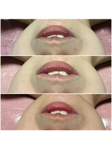 トータルビューティサロン リボーテ(Re:Beaute)/スポットシミケア