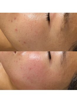 ヨルエステ(yoru aesthe)/【ハーブトリートメント2回目】