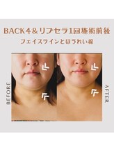 エステティックサロン やすらぎ心花(konoka)/ほうれい線改善で印象こんなに！