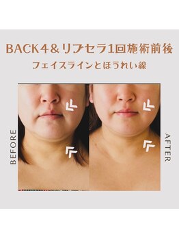 エステティックサロン やすらぎ心花(konoka)/ほうれい線改善で印象こんなに！