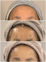 ブリノス(BLINOSS)/オーダーメイドフェイシャル