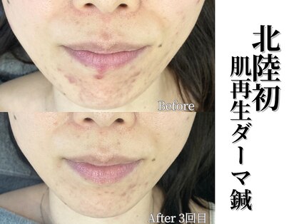 ココハリの写真