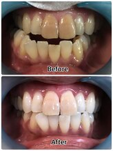 ドクターモック(Dr.MOC)/ＢＥＦＯＲＥ→ＡＦＴＥＲ