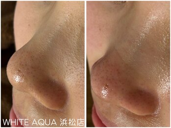 ホワイトアクア 浜松店(WHITE AQUA)/毛穴ケア/毛穴洗浄/浜松