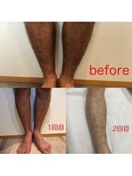 ベルフィーヌボーテ(BELFINE beaute)/メンズ脱毛