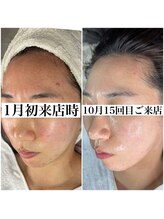 レイ(Rey)/鏡を見てしまうお肌へ大変化☆