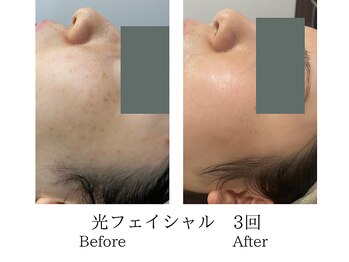 ミーシェ(Meshie)/光フェイシャル術後