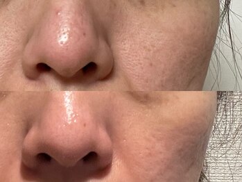 ゾーンビューティーハウス 柏店(ZONE BEAUTY HOUSE)/☆毛穴ケアならお任せください☆