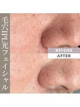 メロウ(mellow)/鼻の毛穴黒ずみに☆