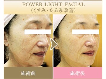 ビューティースペース 品川大井町店(Beauty Space)/光フェイシャル