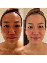 ルナスーリヤ 表参道店/ハーブピーリングの変化