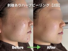 リソルバイスリール(Re:sol by sourire)/毛穴洗浄・ハーブピーリング専門