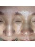 一押し☆新規【NO産毛!艶肌爆誕♪】フェイスWAX脱毛+眉毛SET¥10480→¥7500