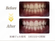 ホワイトニングプラス 六本木店の雰囲気（痛みが少なく1度で効果実感できます。#ホワイトニング/六本木）
