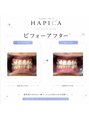 ハピカ 西谷(HAPICA)/角屋　恵子