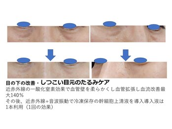 スキャニング@ラボエステ/冷凍保存の幹細胞上清液導入