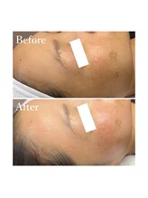 ホワイトワックス 京都四条烏丸(WHITE WAX)/全顔フェイシャルワックス