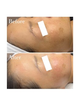 ホワイトワックス 京都四条烏丸(WHITE WAX)/全顔フェイシャルワックス