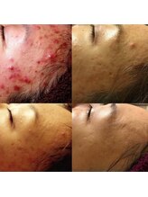 シャルム エスボーテ(charme Esbeaute)/業界No1ハーブピーリング