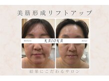 美筋フェイシャル専門サロン カイオナ(KAIONA)/1度で別人級リフトアップ♪
