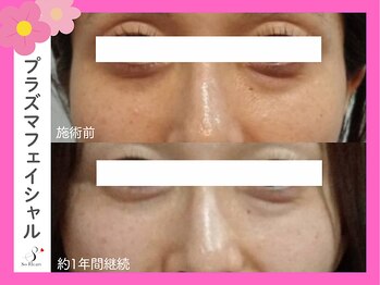 ソーハート(So Heart)/目元のしわ改善☆トーンアップ☆