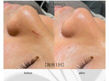 アン ビューティー(ann beauty)/施術1回【症例写真】10代