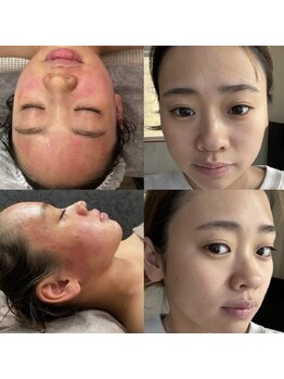 マナ(mana)/皮膚常在菌のバランスを安定☆