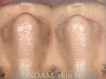 オンダム 表参道(ONDAM)/頑固な毛穴/黒ずみにも効果抜群
