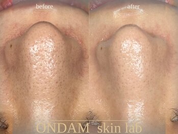 オンダム 表参道(ONDAM)/頑固な毛穴/黒ずみにも効果抜群