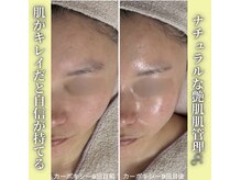 ハニエル(Haniel)/カーボキシー症例