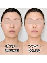 ブルーエ(bleuet)/一回の施術でリフトアップ