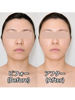 ブルーエ(bleuet)/一回の施術でリフトアップ