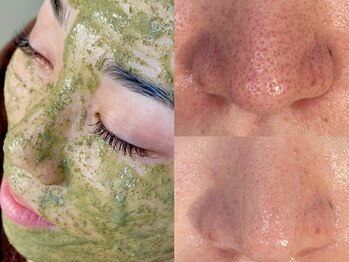 レシェルサロン(Lechelle Salon)の写真/毛穴にお悩みの方必見！福岡天神・薬院の人気サロンの毛穴改善ハーブピーリング でつるんっと毛穴陶器肌♪