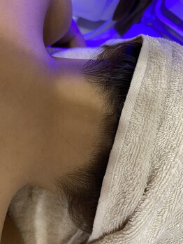 アミラ(Amira)/うなじ脱毛