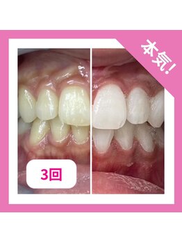 オハシロ 石橋駅前店(Ohashiro)/美白ホワイトニングセットがお得