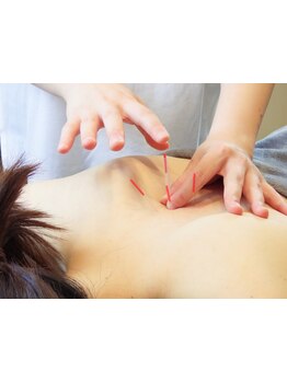 鍼灸施術を受けたい