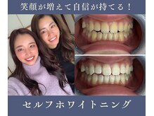 グリッター ショウナン(glitter.SHONAN)の雰囲気（短時間で早く白くしたい方にオススメ♪）