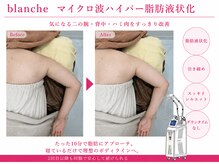 オリエンタルローザ 表参道(Oriental Rosa)/マイクロ波ハイパー脂肪液化術！