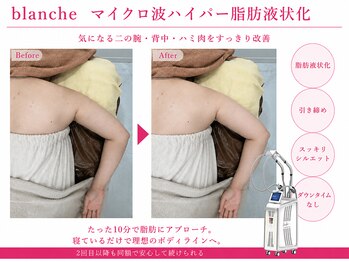 オリエンタルローザ 表参道(Oriental Rosa)/マイクロ波ハイパー脂肪液化術！