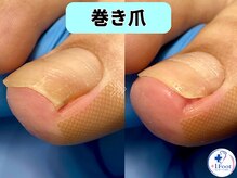プラスワンフット 本厚木(+1 Foot)/巻き爪矯正は専門店へ●