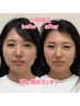 【小顔矯正】激変超人気の小顔矯正コース50分 12000円→7000円