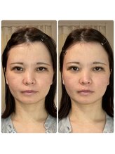 シエン ボーテ 馬車道 関内(Cyen BEAUTE)/一回でのビフォーアフター