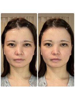 シエン ボーテ 馬車道 関内(Cyen BEAUTE)/一回でのビフォーアフター