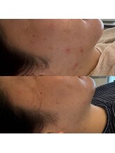 モア 吉祥寺(MORE.)/ハーブピーリングBefore after