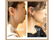 シャンティ ボーテ(Shanti Beaute)/たるみ＆引き締め小顔コース