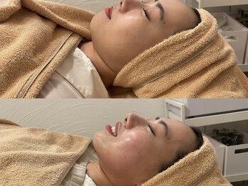 ストリ(STRI)/美容鍼before、after