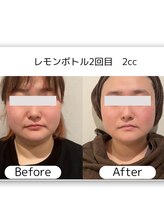 なごみ 菊池店/脂肪撃退【レモンボトル2cc】