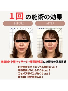 クローバー鍼灸整骨院/美容鍼+小顔矯正マッサージ