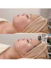 シュリー(Sriii)/インディバ×レモンボトル症例